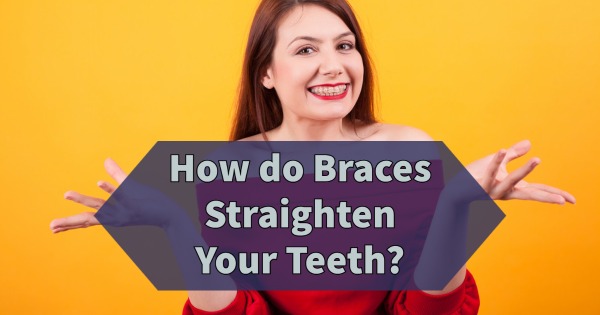 How Do Braces Straighten Your Teeth?