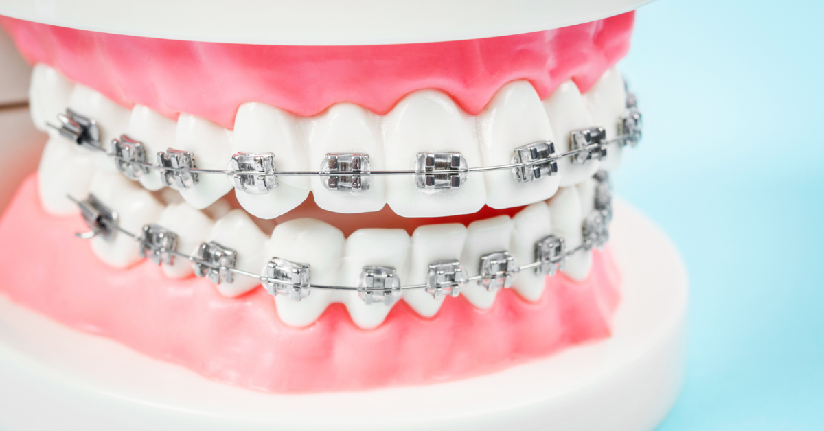 Affordable Braces in Jacksonville, FL: Smiley Face is the place!