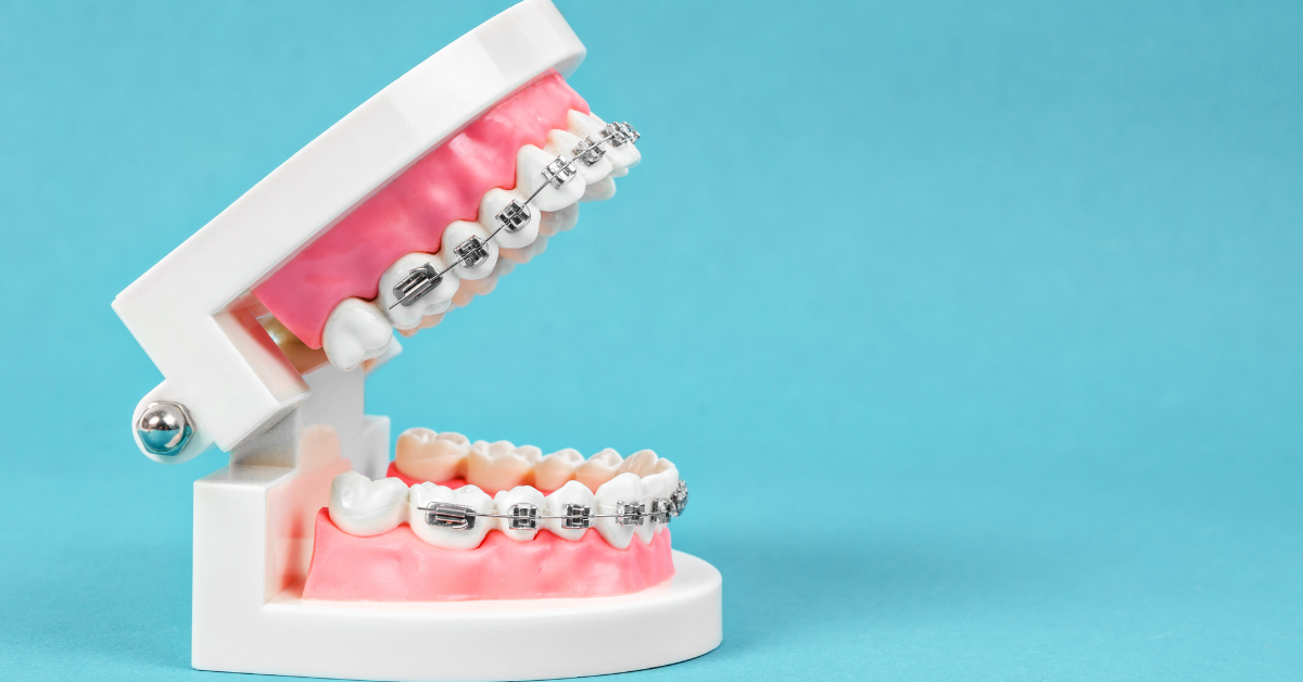 How Long Do Braces Take in Jacksonville, FL? What Patients Should Expect